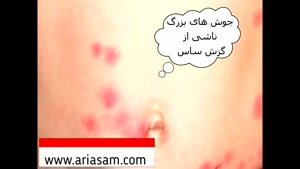 چطور جای نیش ساس را تشخیص دهیم