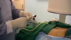 فیلم جراحی سنگ بزرگ کلیه به روش آندوسکوپی بدون شکاف