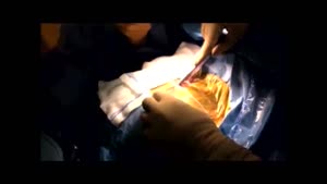 عمل جراحی باز کرانیوتومی Retrosigmoid