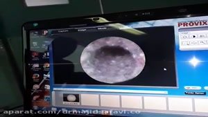تعبیه استنت در محل تنگی مجرای ادرار