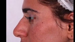 معرفی بیمار جراحی بینی