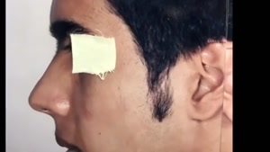 جراحی بینی بیمار با انحراف شدید