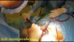 عمل جراحی تعویض کامل مفصل لگن توسط دکتر امین جواهری