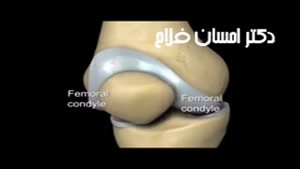 فیلم جراحی تعویض مفصل زانو