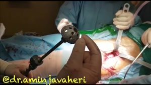 ویدیو جراحی تعویض مفصل لگن توسط جراح امین جواهری