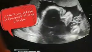 سونوگرافی جنین 27 هفته ای
