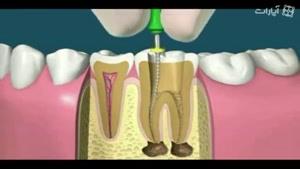 چه جوری دندونات پر میشه؟