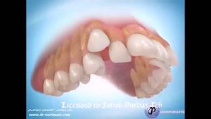 دندانی فدای دندانی دیگر ارتودنسی