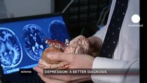 مغز بیماران مبتلا به افسردگی کوچک می شود