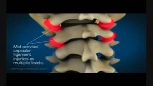 دردهای گردنی ناشی از درگیری مفاصل