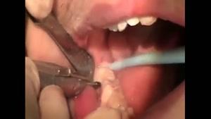 کشیدن دندان های عقل