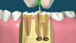 عصب کشی دندان ها