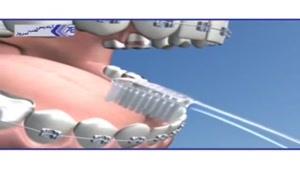 بهداشت دهان و دندان در بیماران ارتودنسی