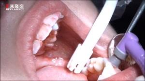  افزایش چشمگیر آمار پوسیدگی دندان در ایران