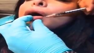 How to to do Lip Augmentation چگونگى انجام پروتز لب