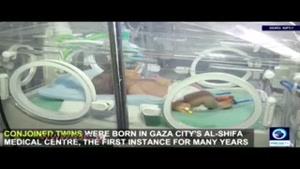 تولد نوزاد دو سر در نواز غزه