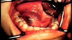 عمل جراحی از EPIDERMOID کیست از کف دهان
