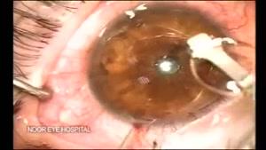 عمل جراحی لنز داخل چشمی Artiflex IOL