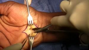 جراحی عصب دست