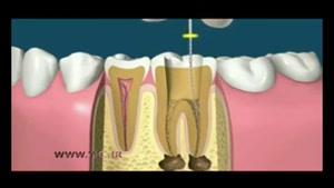 ویدئوی جالب از عصب كشى و روكش كردن دندان 