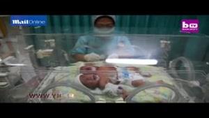 تولد نادر یک نوزاد 2 سر در اندونزی