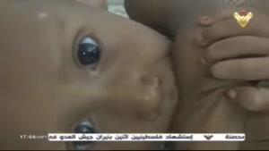 فیلم/ سوء تغذیه کودکان یمنی
