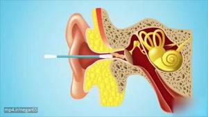 هشدار :هرگز گوشتان را با گوش پاک کن تمیز نکنید!!!