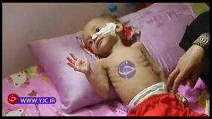 جلوگیری عربستان از رسیدن کمک‌های مردمی به 7 میلیون کودک بیمار یمنی