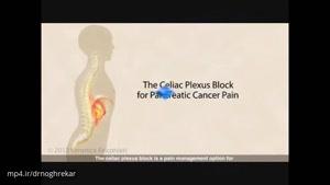 بلوک شبکه سلیاک، درمانی برای کاهش دردهای سرطانی شکم