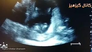 تصاویر سونوگرافی از جنین این بچه تو شکم مادرش با آواز خوندن پدر و مادرش دست میزنه! 😍😄