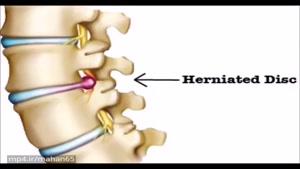 جراحي ديسك كمرباليزربدون نياز به بازكردن محلل وبستري يك روش جديد در اروپا امريكاست