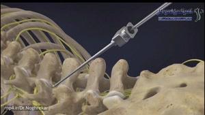 دستگاه محرک طناب نخاعی (SCS) برای دردهای لاعلاج