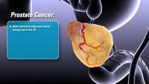 سرطان پروستات