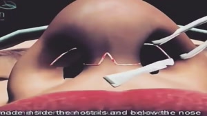 انیمیشن جراحی بینی