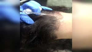مزوتراپی مو در زنان 