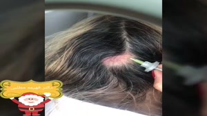 درمان ریزش مو با کربوکسی تراپی 
