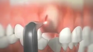 ارتودنسی دندان نیش