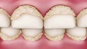 تحلیل رفتن لثه و لق شدن دندان ها بر اثر جرم ایجاد شده