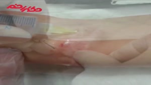فیلم جراحی ترمیم اسکار در ناحیه ی مچ دست