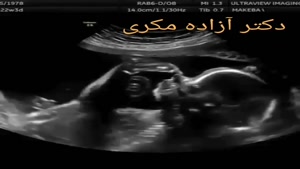  سونوگرافی بارداری دو قلو