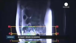 اسکن سه بعدی مغز جنین