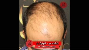  کاشت مو | فیلم کاشت مو | کلینیک پوست و مو رز | شماره 38