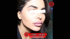 تزریق چربی | فیلم تزریق چربی | کلینیک پوست و مو رز | شماره 65