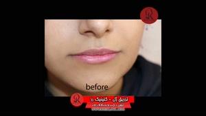 تزریق ژل | فیلم تزریق ژل | کلینیک پوست و مو رز | شماره 46