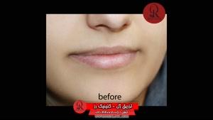 تزریق ژل | فیلم تزریق ژل | کلینیک پوست و مو رز | شماره 47