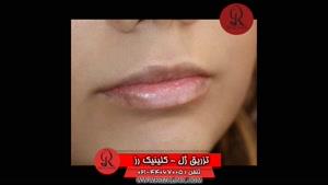  تزریق ژل | فیلم تزریق ژل | کلینیک پوست و مو رز | شماره 52 