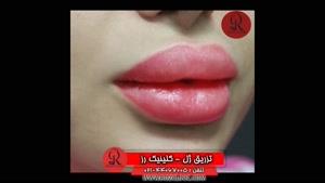  تزریق ژل | فیلم تزریق ژل | کلینیک پوست و مو رز | شماره 53