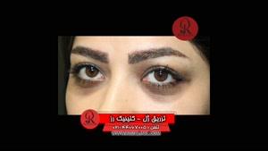  تزریق ژل | فیلم تزریق ژل | کلینیک پوست و مو رز | شماره 50 