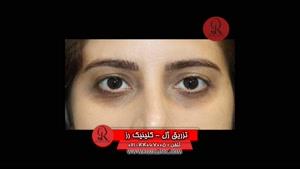  تزریق ژل | فیلم تزریق ژل | کلینیک پوست و مو رز | شماره 51