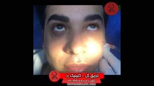 تزریق ژل | فیلم تزریق ژل | کلینیک پوست و مو رز | شماره  54